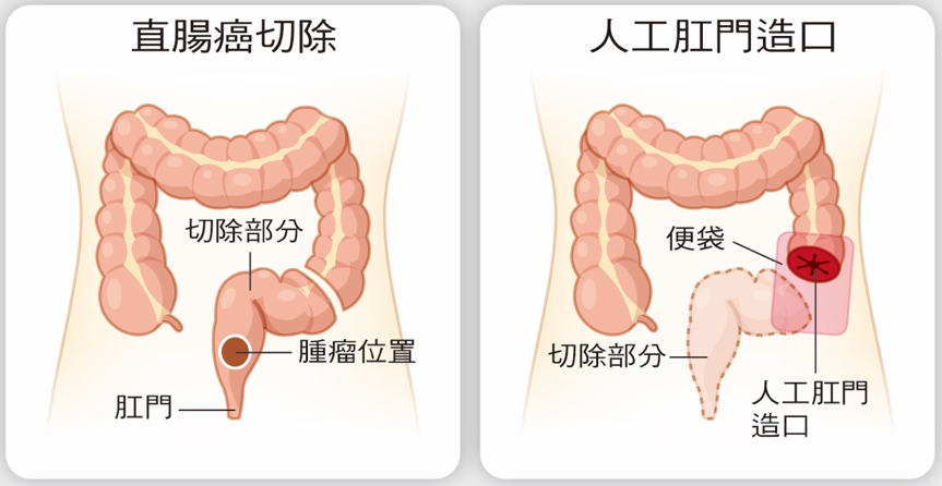 三百年来，人类如何试着「帮肠子找到出路」：人工肛门的诞生04