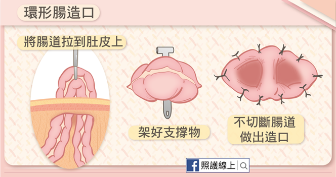 三百年来，人类如何试着「帮肠子找到出路」：人工肛门的诞生06