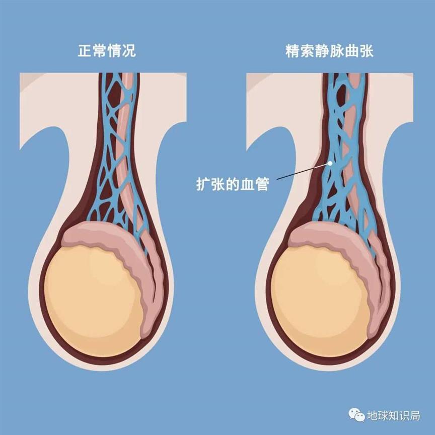 男人精子数量，断崖式下降！| 地球知识局