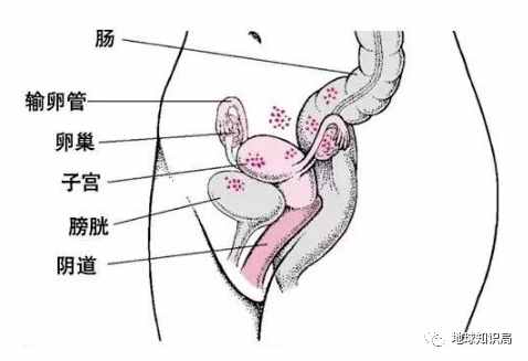 切除子宫的人，越来越多了 | 地球知识局