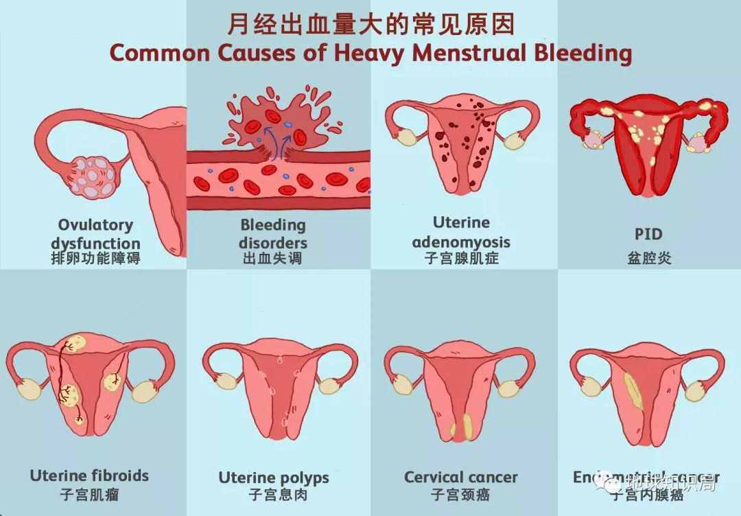 切除子宫的人，越来越多了 | 地球知识局