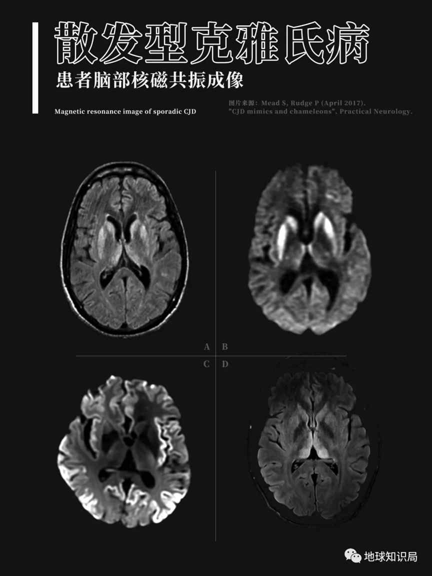 这种病，让人变成丧尸？| 地球知识局