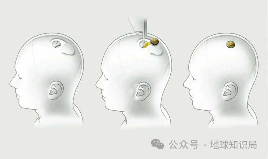 美国最新技术来了，专搞人的脑子 | 地球知识局