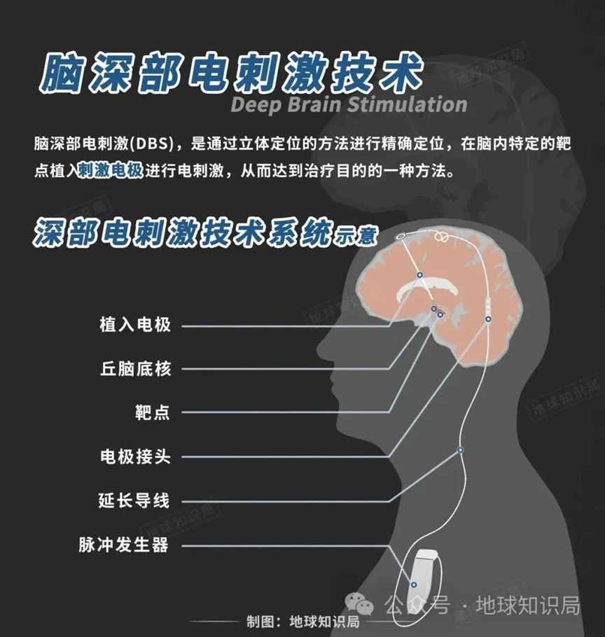 美国最新技术来了，专搞人的脑子 | 地球知识局