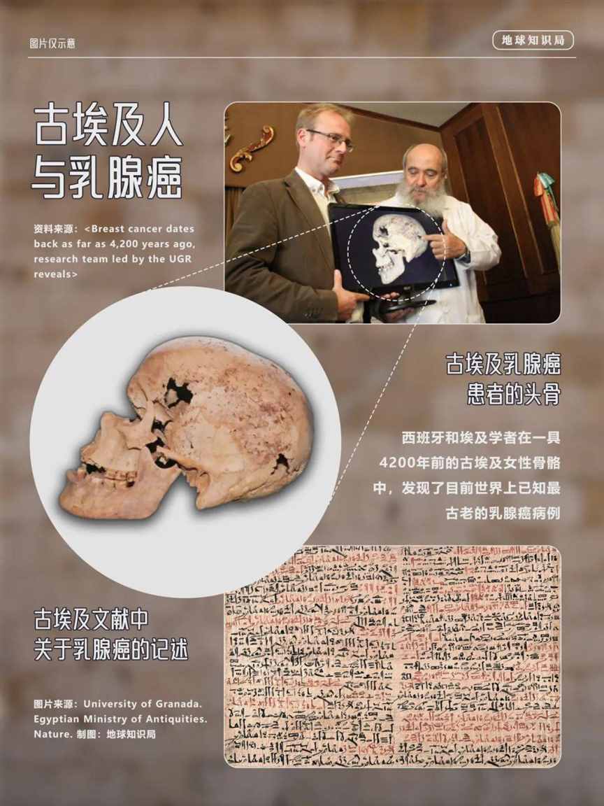 乳房第一杀手，每年两百多万 | 地球知识局