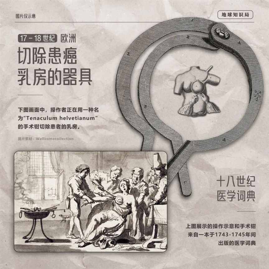 乳房第一杀手，每年两百多万 | 地球知识局