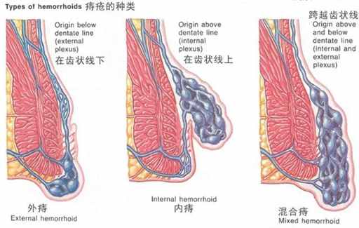中国哪个省，痔疮比例最高? | 地球知识局